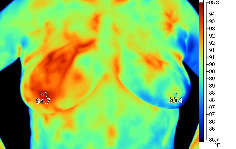 Warm mass in R breast